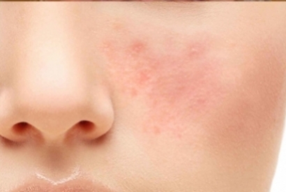 Stařecké akné - Rosacea - Acne Rosacea